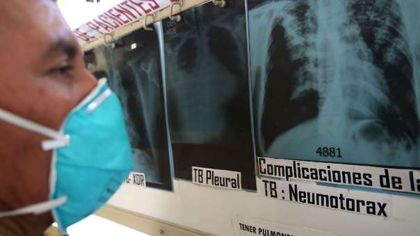 Perú registra 31, 668 personas afectadas por tuberculosis y el 25% pertenecen a nuestra región