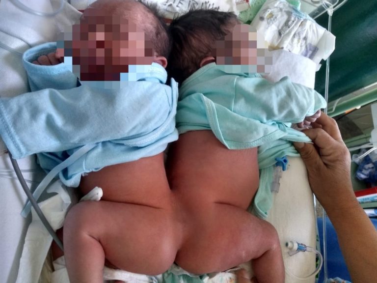 Bebés siameses serán separados en el Hospital III Goyeneche
