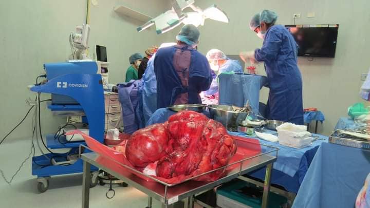 Extraen un tumor de 25 kilos del abdomen de una paciente en el IREN Sur