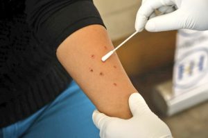 Confirman primer caso de viruela del mono en Arequipa