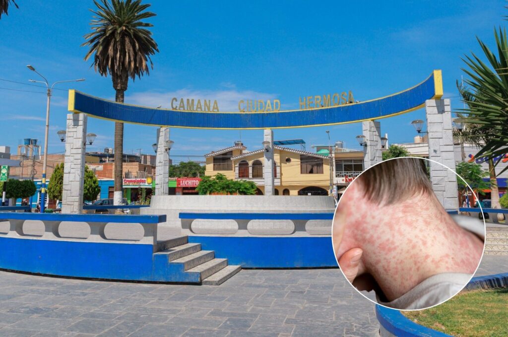sarampión